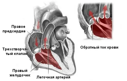 Пролапс трикуспідального клапана