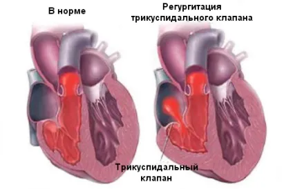 Пролапс трикуспідального клапана