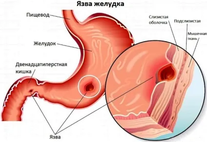 Воротар шлунка і його хвороби стеноз, недостатність, виразка (стеноз) Воротар шлунка і його хвороби стеноз, недостатність, виразка