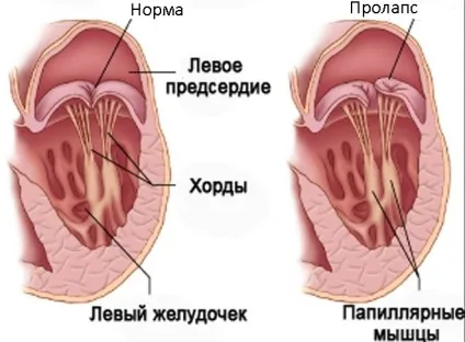 Пролапс у дітей причини, симптоми, лікування, фото, відео (пролапс) Пролапс у дітей причини, симптоми, лікування, фото, відео