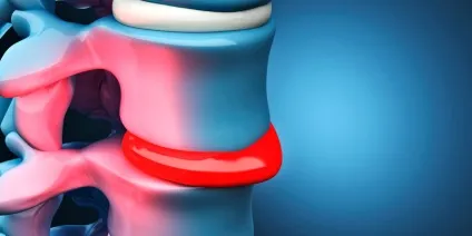 Протрузія дисків хребта