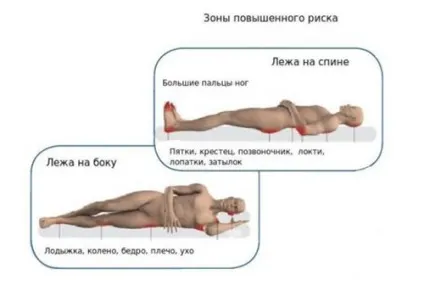 Протипролежневий матрац - відгуки, який краще (протипролежневі) Протипролежневий матрац - відгуки, який краще