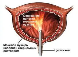 Рак сечового міхура - причини, симптоми і лікування (причини) Рак сечового міхура - причини, симптоми і лікування