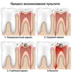 Пульпіт зуба що це таке класифікація, симптоми і лікування (класифікація) Пульпіт зуба що це таке класифікація, симптоми і лікування