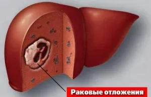 Рак печінки - симптоми, фото, ознаки, лікування раку печінки (ознаки) Рак печінки - симптоми, фото, ознаки, лікування раку печінки