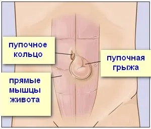 Пупкова грижа у новонароджених - сіпмтоми, причини і лікування консервативне та хірургічне (консервативне) Пупкова грижа у новонароджених - сіпмтоми, причини і лікування консервативне та хірургічне
