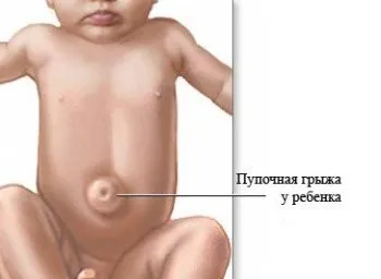 Пупкова грижа у дітей