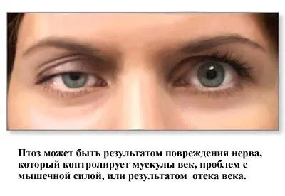 Птоз верхню повіку причини, лікування народними засобами без операції, після ботокса, в домашніх