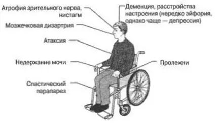 Розсіяний склероз симптоми у жінок на початковій стадії, причини виникнення, як (склероз) Розсіяний склероз симптоми у жінок на початковій стадії, причини виникнення, як