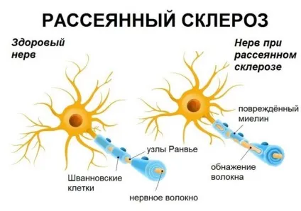 Розсіяний склероз симптоми у жінок на початковій стадії, причини виникнення, як (симптоми) Розсіяний склероз симптоми у жінок на початковій стадії, причини виникнення, як