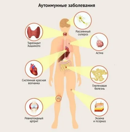 Розсіяний склероз симптоми у жінок на початковій стадії, причини виникнення, як (жінок) Розсіяний склероз симптоми у жінок на початковій стадії, причини виникнення, як