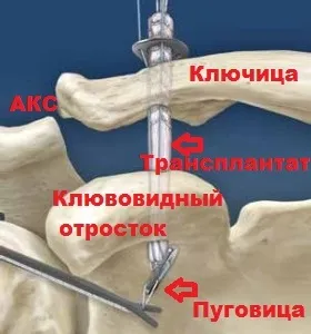 Розрив зв'язок акромиально-ключичного зчленування плеча (зчленування) Розрив зв'язок акромиально-ключичного зчленування плеча