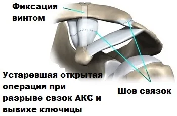 Розрив зв'язок акромиально-ключичного зчленування плеча (розрив) Розрив зв'язок акромиально-ключичного зчленування плеча