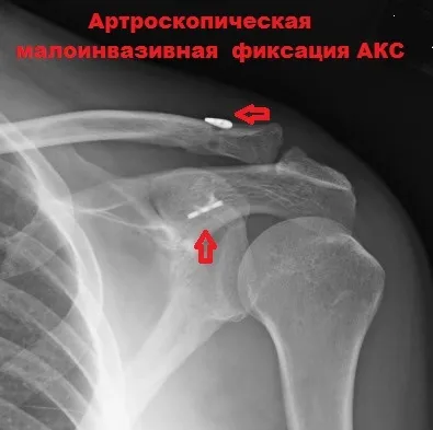 Розрив зв'язок акромиально-ключичного зчленування плеча (розрив зв'язки акромиально-ключичное зчленування плечовий суглоб) Розрив зв'язок акромиально-ключичного зчленування плеча