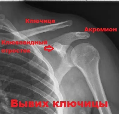 Розрив зв'язок акромиально-ключичного зчленування плеча (зчленування) Розрив зв'язок акромиально-ключичного зчленування плеча