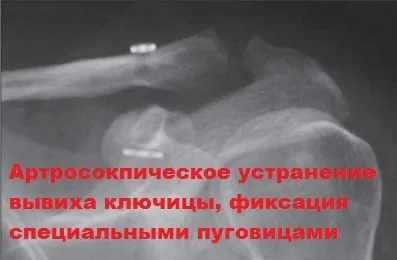 Розрив зв'язок акромиально-ключичного зчленування плеча (зв'язок) Розрив зв'язок акромиально-ключичного зчленування плеча