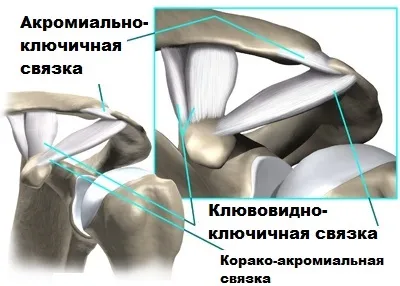 Розрив зв'язок акромиально-ключичного зчленування плеча (зчленування) Розрив зв'язок акромиально-ключичного зчленування плеча