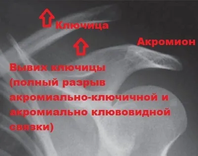 Розрив зв'язок акромиально-ключичного зчленування плеча (акромиально-ключичного) Розрив зв'язок акромиально-ключичного зчленування плеча