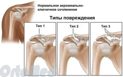 Розрив акромиально-ключичного зчленування симптоми, лікування, операція, розрив акроміальних зв'язок (зчленування) Розрив акромиально-ключичного зчленування симптоми, лікування, операція, розрив акроміальних зв'язок
