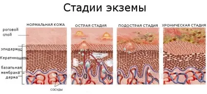 Суха екзема на ногах симптоми, лікування в домашніх умовах, огляд ефективних препаратів (рецепти) Суха екзема на ногах симптоми, лікування в домашніх умовах, огляд ефективних препаратів