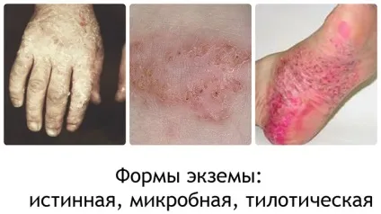 Суха екзема на ногах симптоми, лікування в домашніх умовах, огляд ефективних препаратів (екзема) Суха екзема на ногах симптоми, лікування в домашніх умовах, огляд ефективних препаратів
