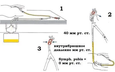 Блювота зеленого кольору у дорослої людини причини, лікування (дорослого) Блювота зеленого кольору у дорослої людини причини, лікування