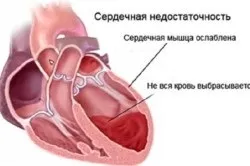 Серцева недостатність що це, види і класи (недостатність) Серцева недостатність що це, види і класи