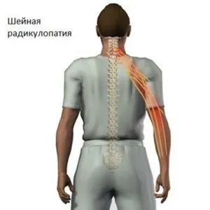 Шийний радикуліт симптоми, лікування в домашніх умовах і традиційні (шийний радикуліт) Шийний радикуліт симптоми, лікування в домашніх умовах і традиційні