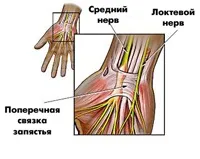 Синдром зап'ястного каналу - причини, симптоми і народні засоби лікування синдрому зап'ястного каналу (синдром) Синдром зап'ястного каналу - причини, симптоми і народні засоби лікування синдрому зап'ястного каналу