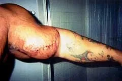 Синтол (synthol)