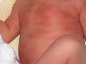 Висип у новонародженого види висипу причини леченіемама - доктор