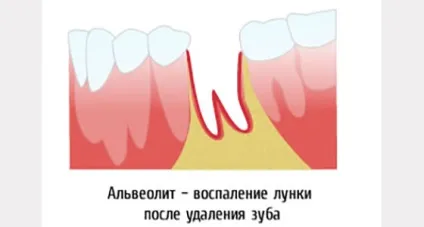 Скільки болить ясна після видалення зуба мудрості - стоматологічний портал (болить) Скільки болить ясна після видалення зуба мудрості - стоматологічний портал