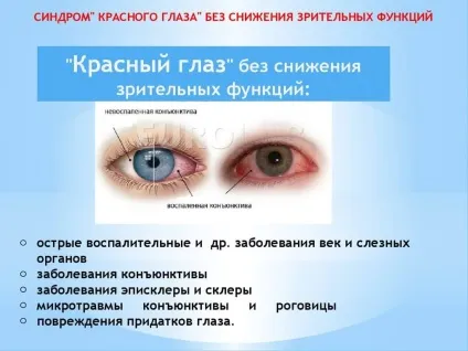 Синдром червоного ока