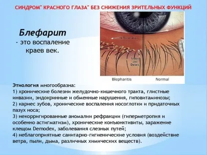 Синдром червоного ока