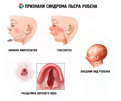 Синдром П'єра Робена причини, симптоми, діагностика, лікування, компетентно про здоров'я на ilive (Робена) Синдром П'єра Робена причини, симптоми, діагностика, лікування, компетентно про здоров'я на ilive