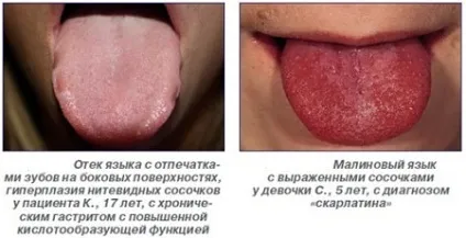 Сліди зубів на мові причини нетертих відбитків з боків і по всій поверхні (на мові відбитки зубів причини) Сліди зубів на мові причини нетертих відбитків з боків і по всій поверхні