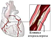 Стенокардія - причини, симптоми, діагностика та лікування (причини) Стенокардія - причини, симптоми, діагностика та лікування
