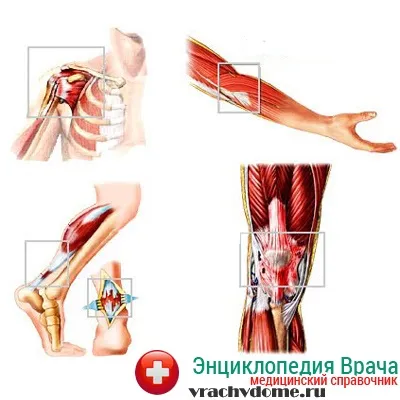 Тендиніт причини симптоми лікування народними засобами (тендиніт народні засоби лікування симптоми тедініта причини) Тендиніт причини симптоми лікування народними засобами