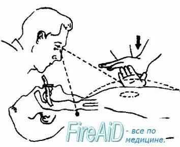 Техніка проведення непрямого масажу серця - методичка по першої допомоги (масажу) Техніка проведення непрямого масажу серця - методичка по першої допомоги
