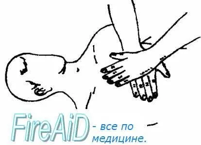 Техніка проведення непрямого масажу серця - методичка по першої допомоги (непрямого) Техніка проведення непрямого масажу серця - методичка по першої допомоги