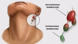 Тонзиліт в хронічній формі симптоми, ускладнення, лікування мигдалин (тонзиліт хронічний лікування симптом) Тонзиліт в хронічній формі симптоми, ускладнення, лікування мигдалин