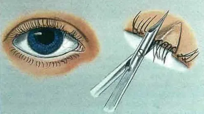 Тріхіаз, лікування трихіазу (Лікування трихіазу методом) Тріхіаз, лікування трихіазу