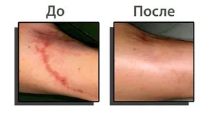 Видалення шрамів на обличчі лазером види шрамів, принцип видалення, ціна і фото до і після (лазером) Видалення шрамів на обличчі лазером види шрамів, принцип видалення, ціна і фото до і після