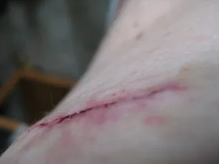 Видалення родимки хірургічним шляхом особливості проведення та методи (видалення) Видалення родимки хірургічним шляхом особливості проведення та методи