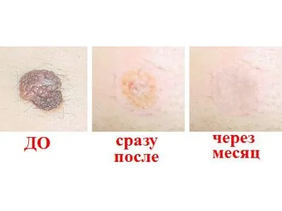 Видалення родимки хірургічним шляхом особливості проведення та методи (хірургічним) Видалення родимки хірургічним шляхом особливості проведення та методи