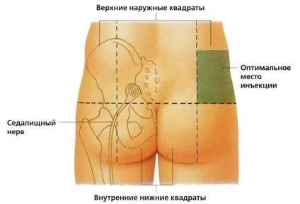 Уколи при бронхіті дорослим