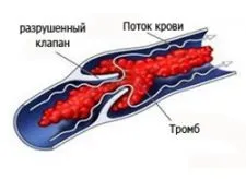 Вам поставили діагноз птфс- що це таке