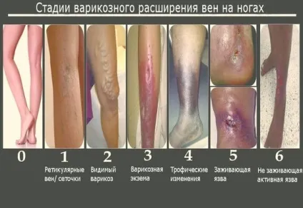 Варикоз на ногах початкова стадія як лікувати, профілактика (стадія) Варикоз на ногах початкова стадія як лікувати, профілактика