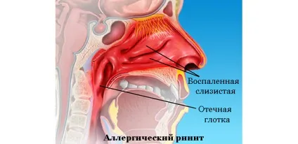 Вазомоторний алергічний риніт - симптоми і лікування нежиті (риніт) Вазомоторний алергічний риніт - симптоми і лікування нежиті