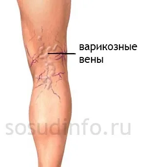 Виступають вени на ногах, руках, грудях причини роздутих судин (виступають) Виступають вени на ногах, руках, грудях причини роздутих судин